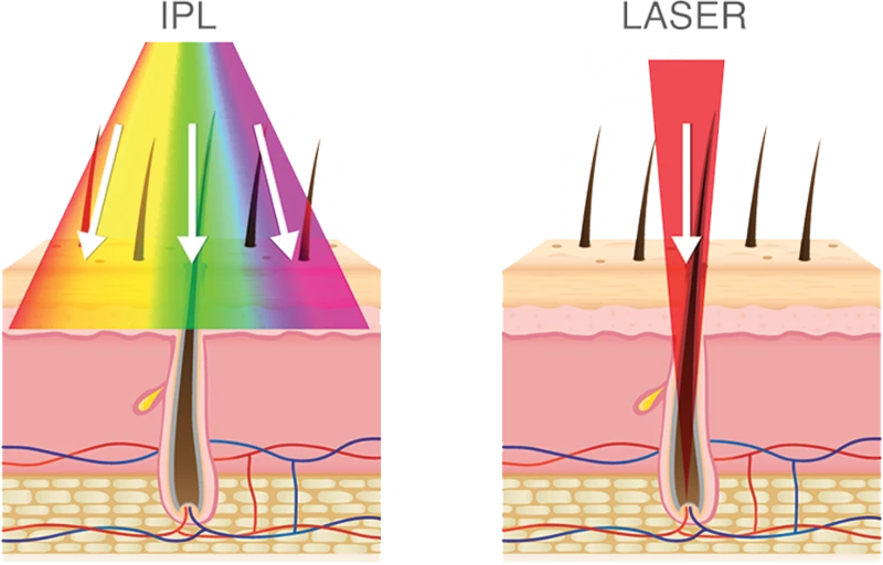 intense pulsed light intense pulsed light