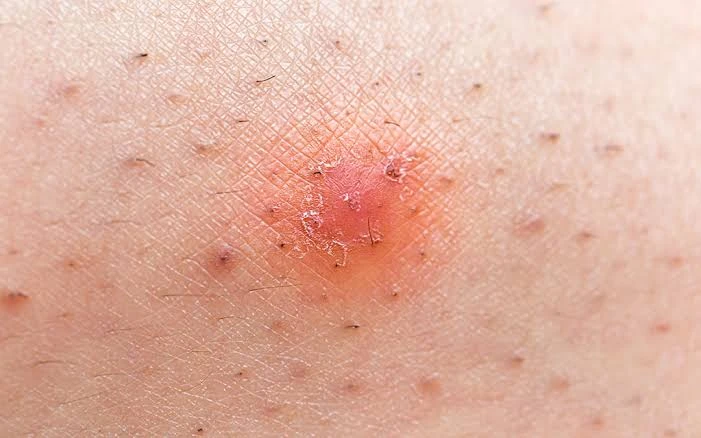 Ingrown Hairs Ingrown Hairs